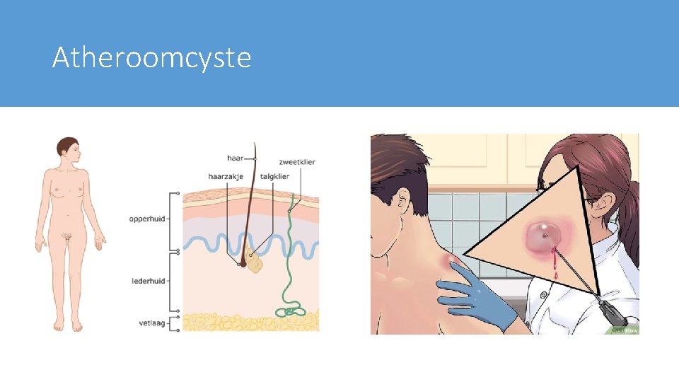 Atheroomcyste 