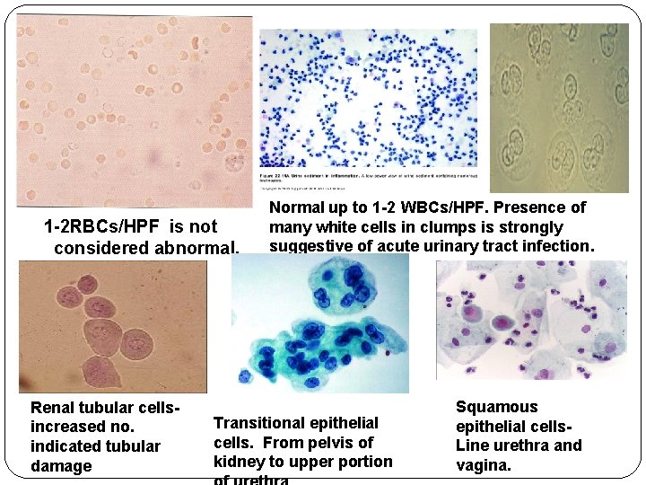 1 -2 RBCs/HPF is not considered abnormal. Renal tubular cellsincreased no. indicated tubular damage