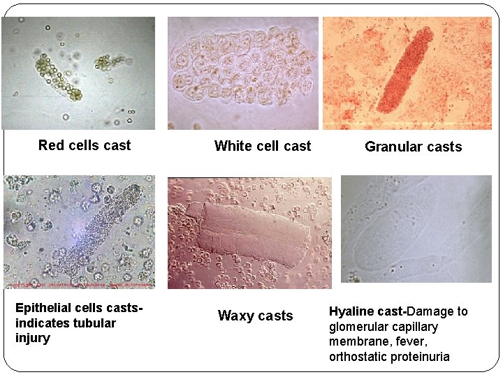 Red cells cast Epithelial cells castsindicates tubular injury White cell cast Waxy casts Granular