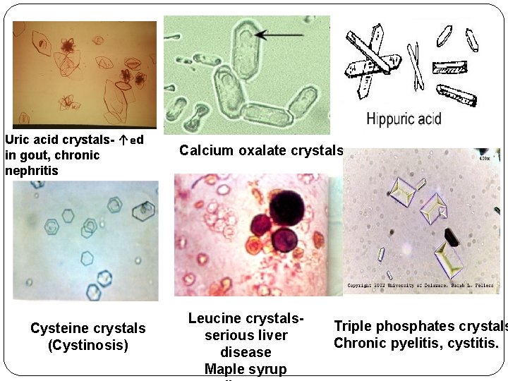 Uric acid crystals- ↑ed in gout, chronic nephritis Cysteine crystals (Cystinosis) Calcium oxalate crystals