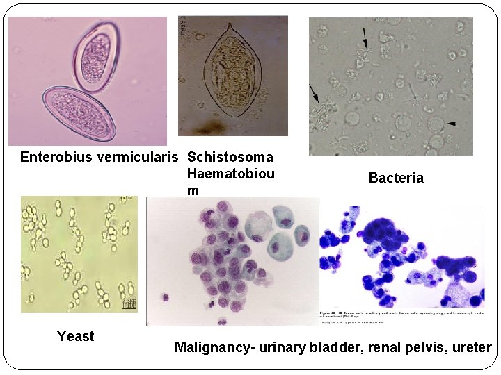 Enterobius vermicularis Schistosoma Haematobiou m Yeast Bacteria Malignancy- urinary bladder, renal pelvis, ureter 