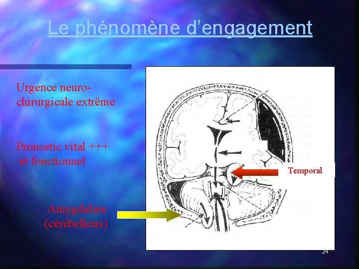 Le phénomène d’engagement Urgence neurochirurgicale extrême Pronostic vital +++ et fonctionnel Temporal Amygdalien (cérébelleux) Le phénomène d’engagement Urgence neurochirurgicale extrême Pronostic vital +++ et fonctionnel Temporal Amygdalien (cérébelleux)