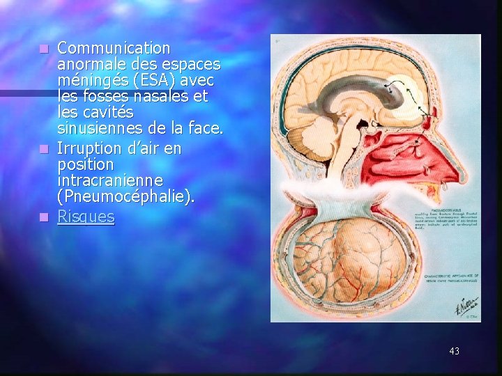 Communication anormale des espaces méningés (ESA) avec les fosses nasales et les cavités sinusiennes Communication anormale des espaces méningés (ESA) avec les fosses nasales et les cavités sinusiennes