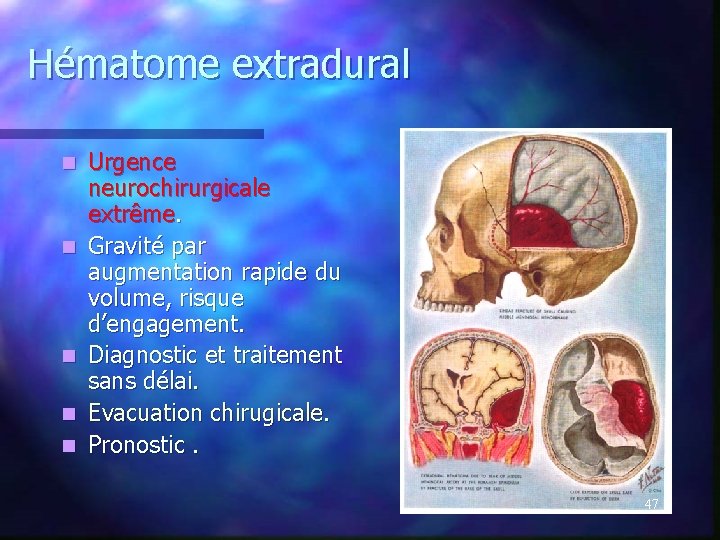Hématome extradural n n n Urgence neurochirurgicale extrême. Gravité par augmentation rapide du volume, Hématome extradural n n n Urgence neurochirurgicale extrême. Gravité par augmentation rapide du volume,