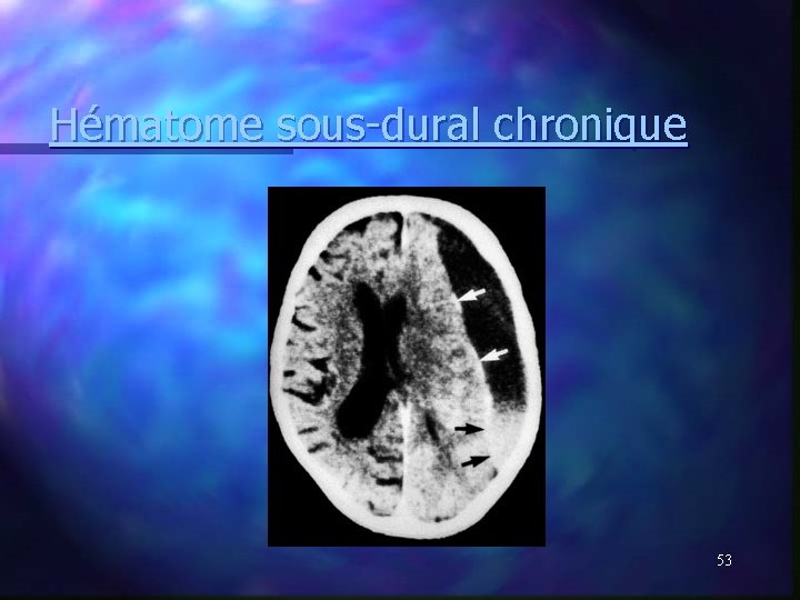 Hématome sous-dural chronique 53 Hématome sous-dural chronique 53