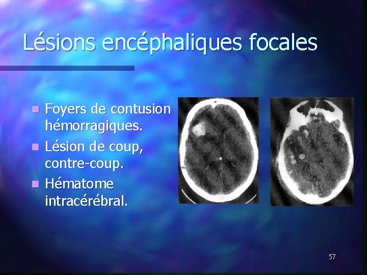 Lésions encéphaliques focales Foyers de contusion hémorragiques. n Lésion de coup, contre-coup. n Hématome Lésions encéphaliques focales Foyers de contusion hémorragiques. n Lésion de coup, contre-coup. n Hématome