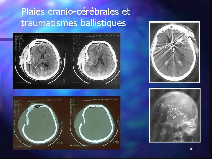 Plaies cranio-cérébrales et traumatismes ballistiques 61 Plaies cranio-cérébrales et traumatismes ballistiques 61