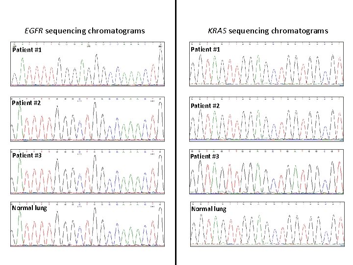 EGFR sequencing chromatograms KRAS sequencing chromatograms Patient #1 Patient #2 Patient #3 Normal lung