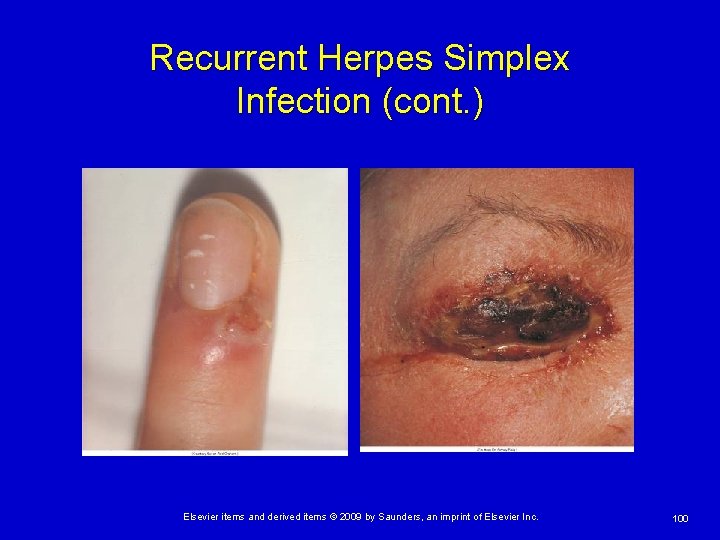 Recurrent Herpes Simplex Infection (cont. ) Elsevier items and derived items © 2009 by