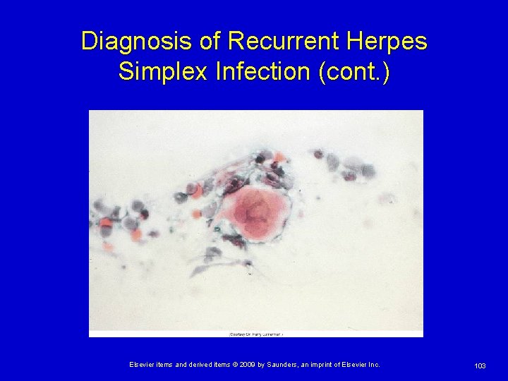 Diagnosis of Recurrent Herpes Simplex Infection (cont. ) Elsevier items and derived items ©