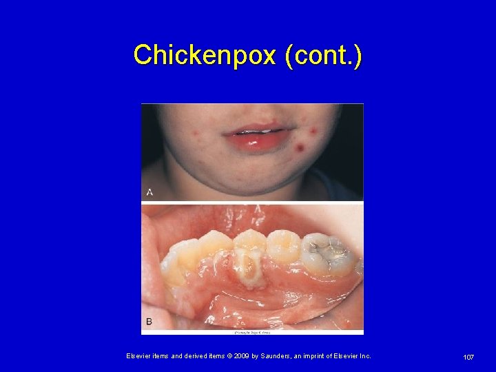 Chickenpox (cont. ) Elsevier items and derived items © 2009 by Saunders, an imprint