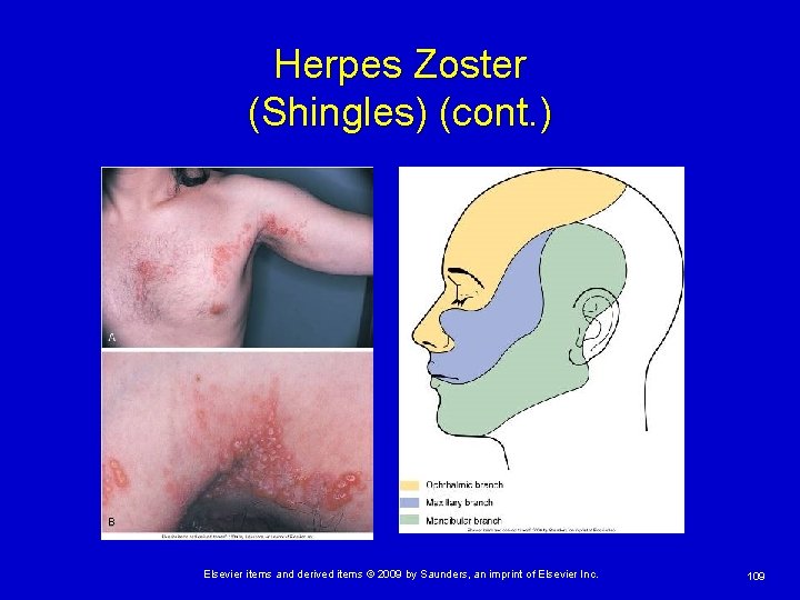 Herpes Zoster (Shingles) (cont. ) Elsevier items and derived items © 2009 by Saunders,