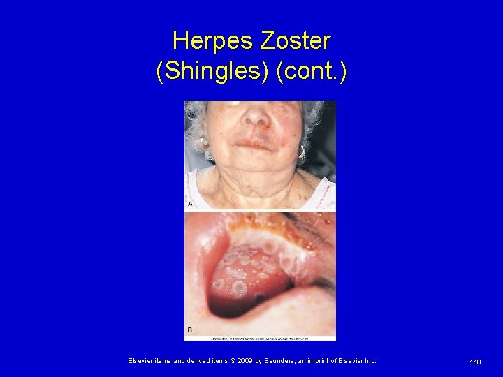 Herpes Zoster (Shingles) (cont. ) Elsevier items and derived items © 2009 by Saunders,