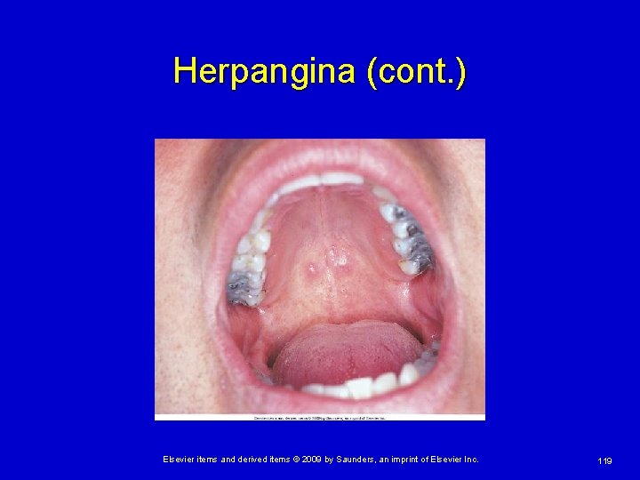 Herpangina (cont. ) Elsevier items and derived items © 2009 by Saunders, an imprint