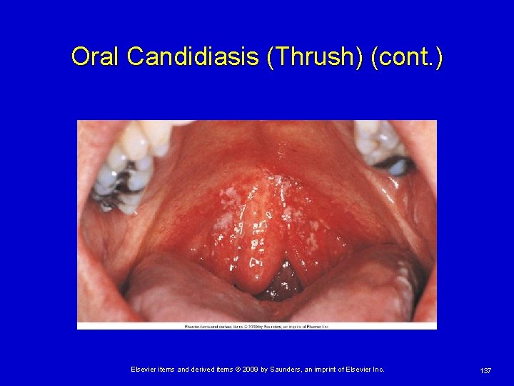 Oral Candidiasis (Thrush) (cont. ) Elsevier items and derived items © 2009 by Saunders,