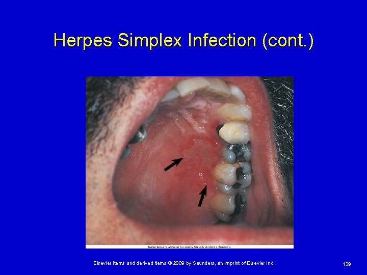 Herpes Simplex Infection (cont. ) Elsevier items and derived items © 2009 by Saunders,