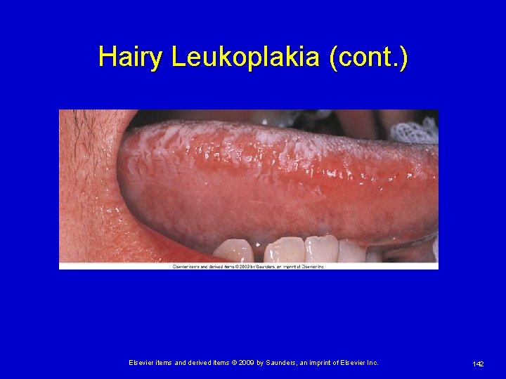 Hairy Leukoplakia (cont. ) Elsevier items and derived items © 2009 by Saunders, an