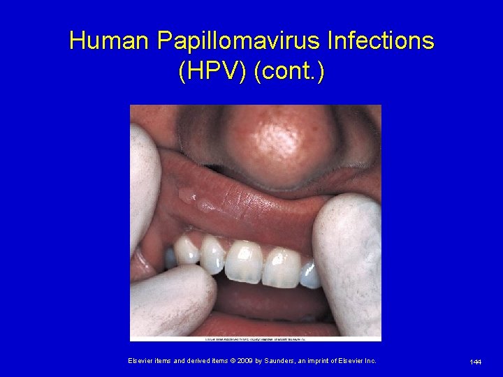 Human Papillomavirus Infections (HPV) (cont. ) Elsevier items and derived items © 2009 by