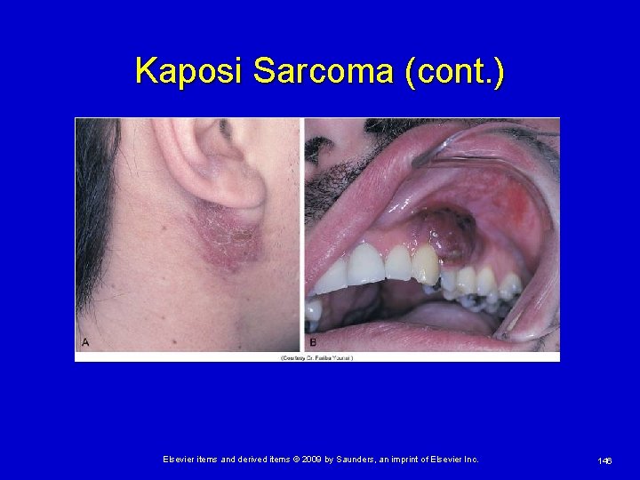 Kaposi Sarcoma (cont. ) Elsevier items and derived items © 2009 by Saunders, an