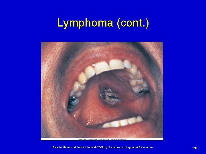 Lymphoma (cont. ) Elsevier items and derived items © 2009 by Saunders, an imprint