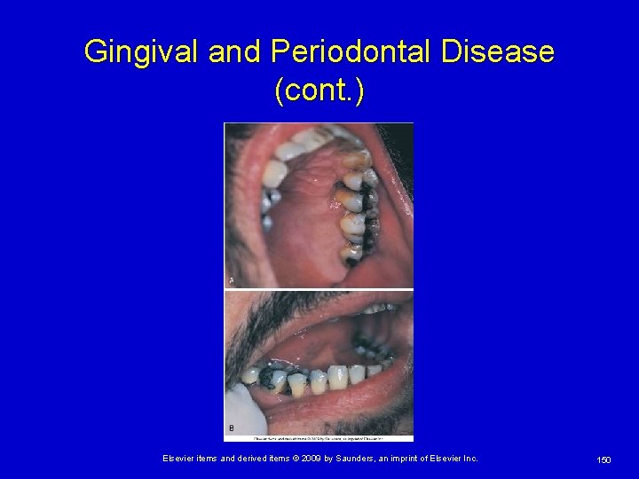 Gingival and Periodontal Disease (cont. ) Elsevier items and derived items © 2009 by