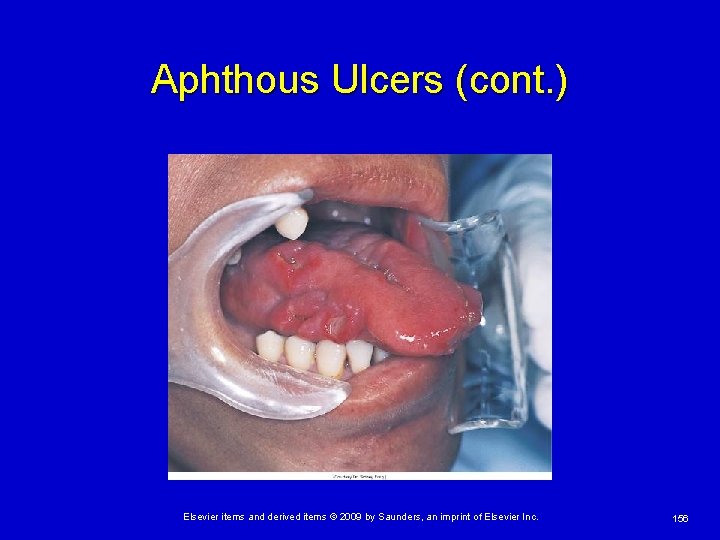Aphthous Ulcers (cont. ) Elsevier items and derived items © 2009 by Saunders, an