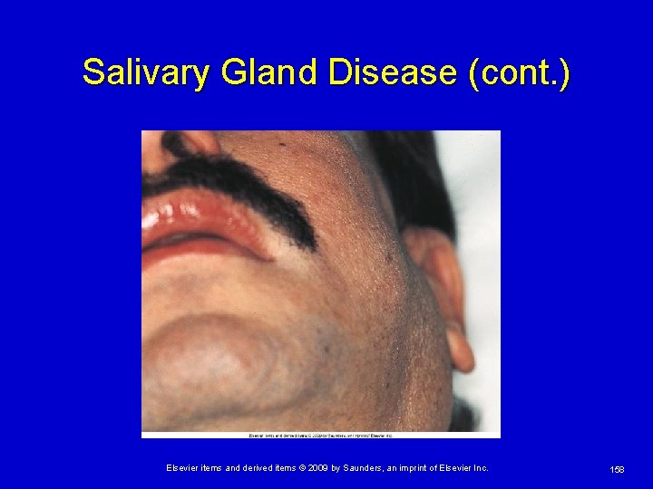 Salivary Gland Disease (cont. ) Elsevier items and derived items © 2009 by Saunders,