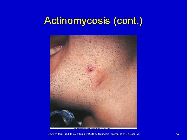 Actinomycosis (cont. ) Elsevier items and derived items © 2009 by Saunders, an imprint