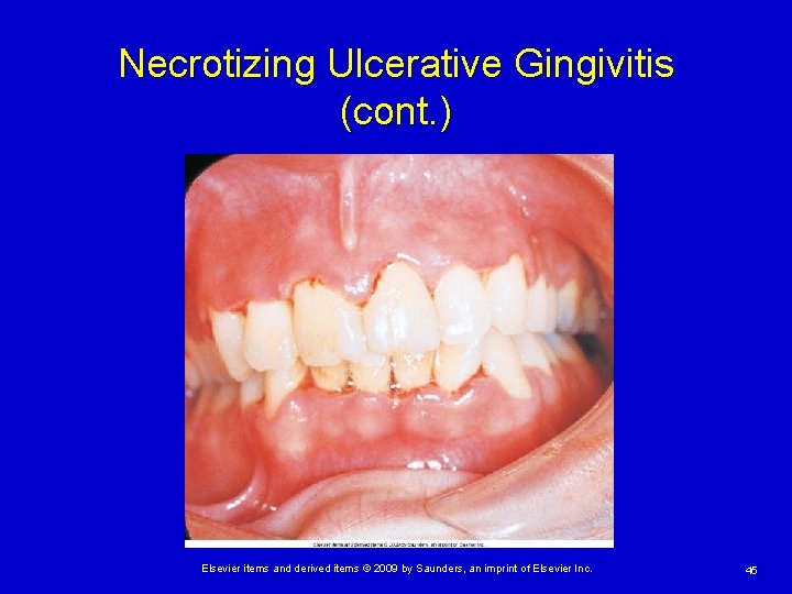 Necrotizing Ulcerative Gingivitis (cont. ) Elsevier items and derived items © 2009 by Saunders,