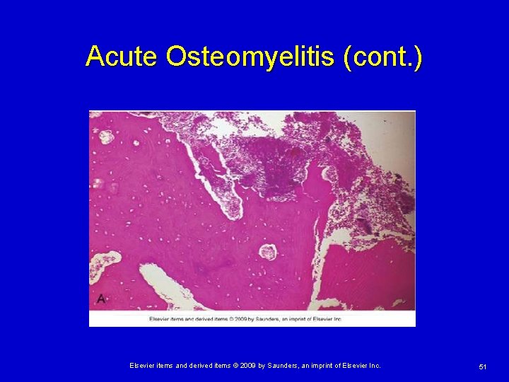 Acute Osteomyelitis (cont. ) Elsevier items and derived items © 2009 by Saunders, an