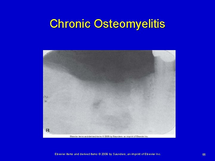 Chronic Osteomyelitis Elsevier items and derived items © 2009 by Saunders, an imprint of