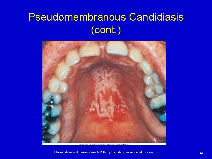 Pseudomembranous Candidiasis (cont. ) Elsevier items and derived items © 2009 by Saunders, an