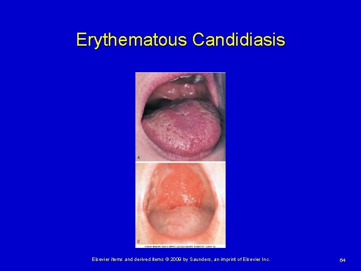Erythematous Candidiasis Elsevier items and derived items © 2009 by Saunders, an imprint of