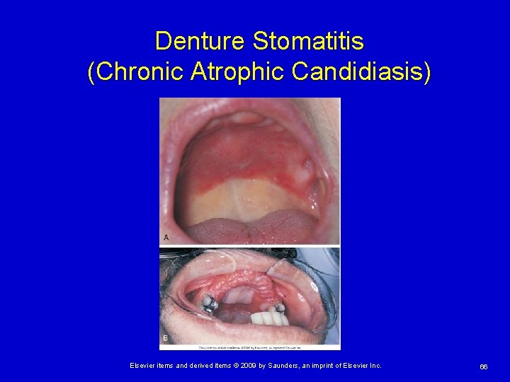 Denture Stomatitis (Chronic Atrophic Candidiasis) Elsevier items and derived items © 2009 by Saunders,