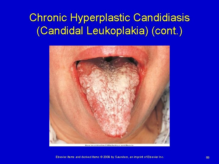 Chronic Hyperplastic Candidiasis (Candidal Leukoplakia) (cont. ) Elsevier items and derived items © 2009