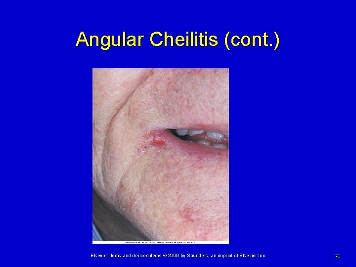 Angular Cheilitis (cont. ) Elsevier items and derived items © 2009 by Saunders, an