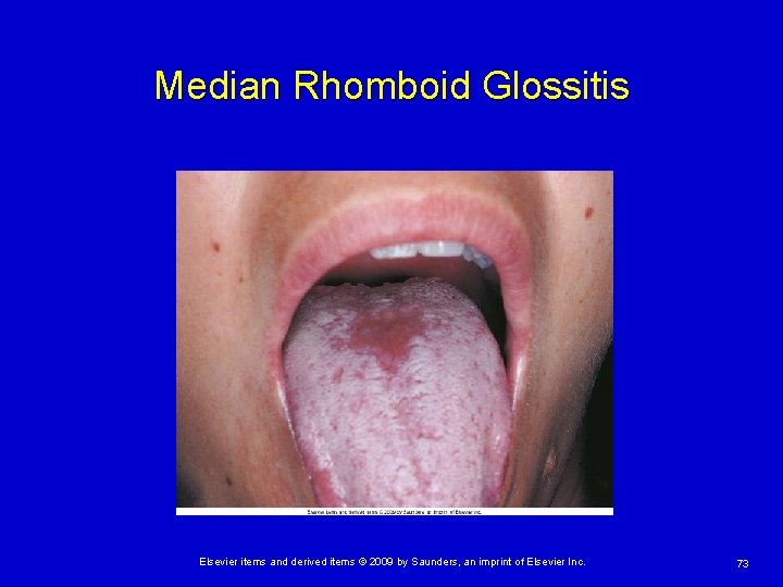 Median Rhomboid Glossitis Elsevier items and derived items © 2009 by Saunders, an imprint