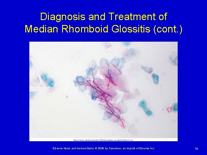 Diagnosis and Treatment of Median Rhomboid Glossitis (cont. ) Elsevier items and derived items