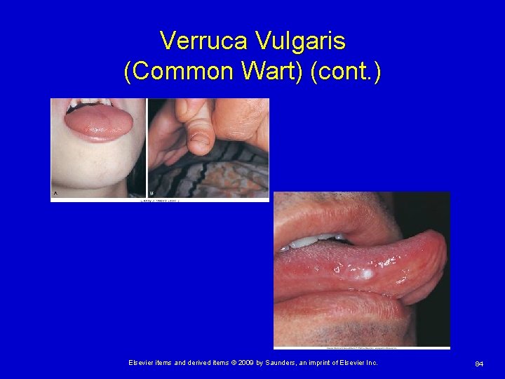 Verruca Vulgaris (Common Wart) (cont. ) Elsevier items and derived items © 2009 by