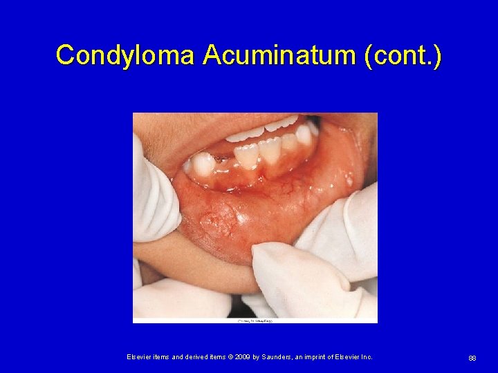 Condyloma Acuminatum (cont. ) Elsevier items and derived items © 2009 by Saunders, an