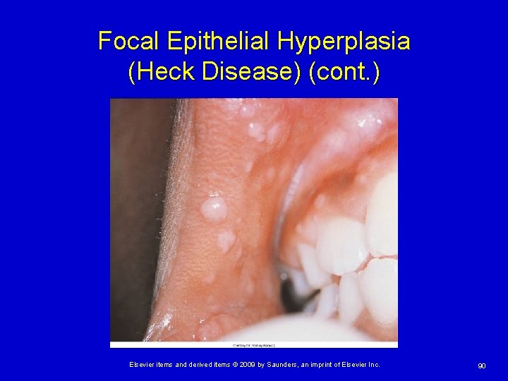 Focal Epithelial Hyperplasia (Heck Disease) (cont. ) Elsevier items and derived items © 2009