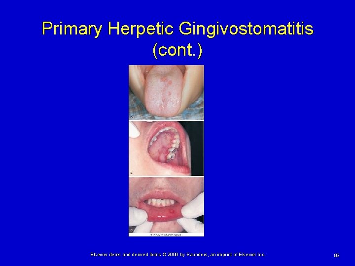 Primary Herpetic Gingivostomatitis (cont. ) Elsevier items and derived items © 2009 by Saunders,