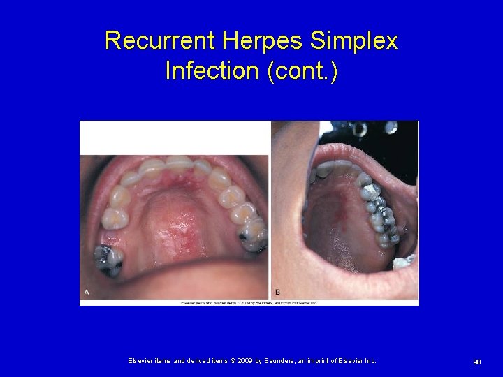 Recurrent Herpes Simplex Infection (cont. ) Elsevier items and derived items © 2009 by