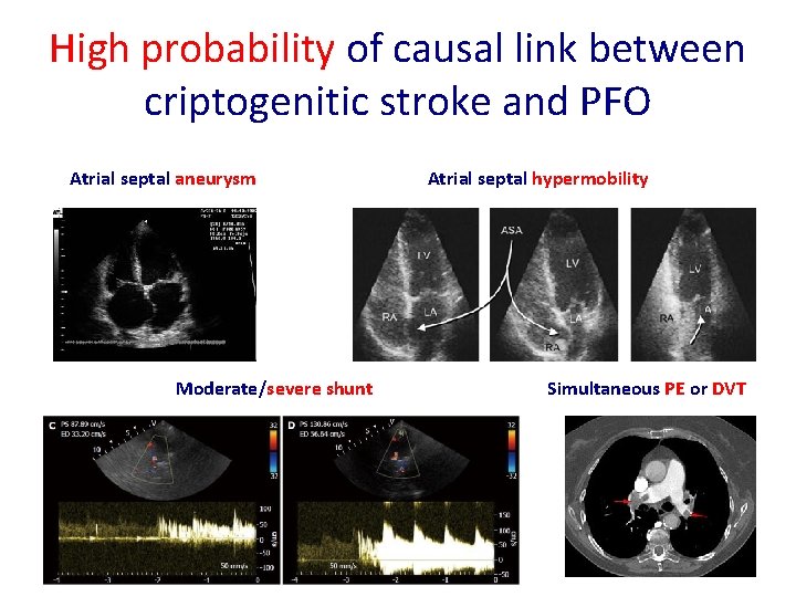 High probability of causal link between criptogenitic stroke and PFO Atrial septal aneurysm Moderate/severe High probability of causal link between criptogenitic stroke and PFO Atrial septal aneurysm Moderate/severe