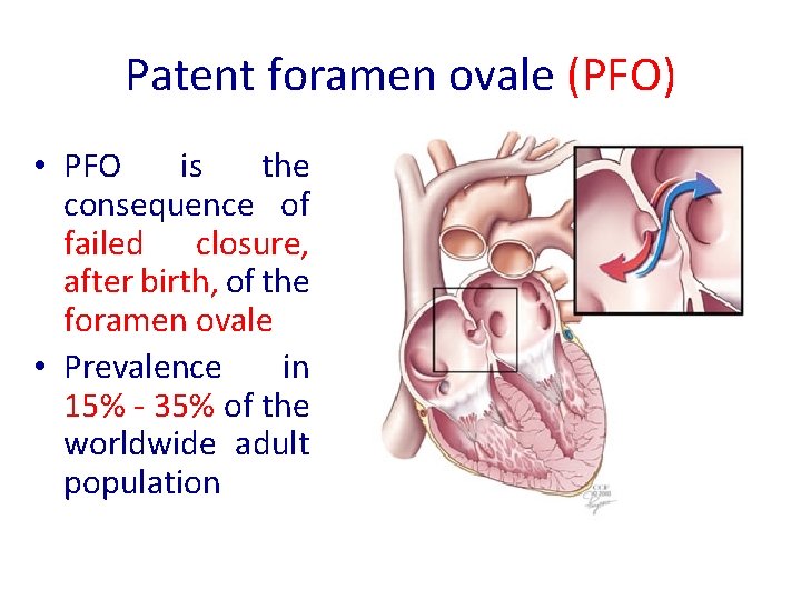 Patent foramen ovale (PFO) • PFO is the consequence of failed closure, after birth, Patent foramen ovale (PFO) • PFO is the consequence of failed closure, after birth,