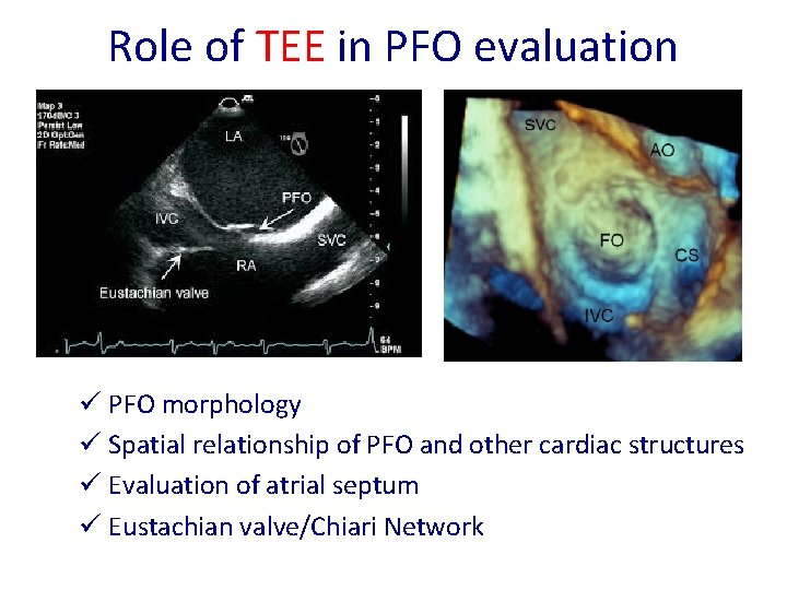 Role of TEE in PFO evaluation ü PFO morphology ü Spatial relationship of PFO Role of TEE in PFO evaluation ü PFO morphology ü Spatial relationship of PFO