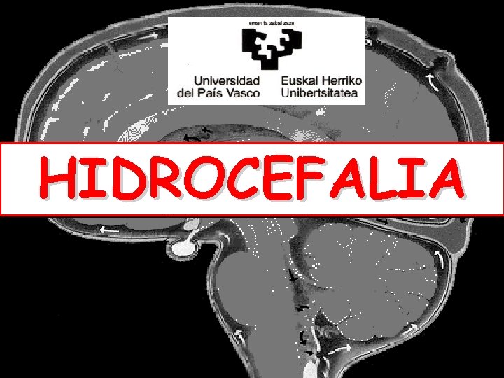 HIDROCEFALIA 