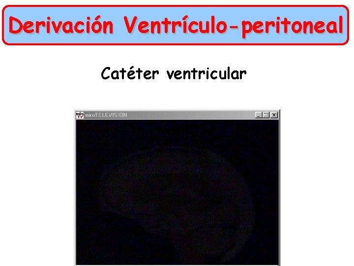 Derivación Ventrículo-peritoneal Catéter ventricular 