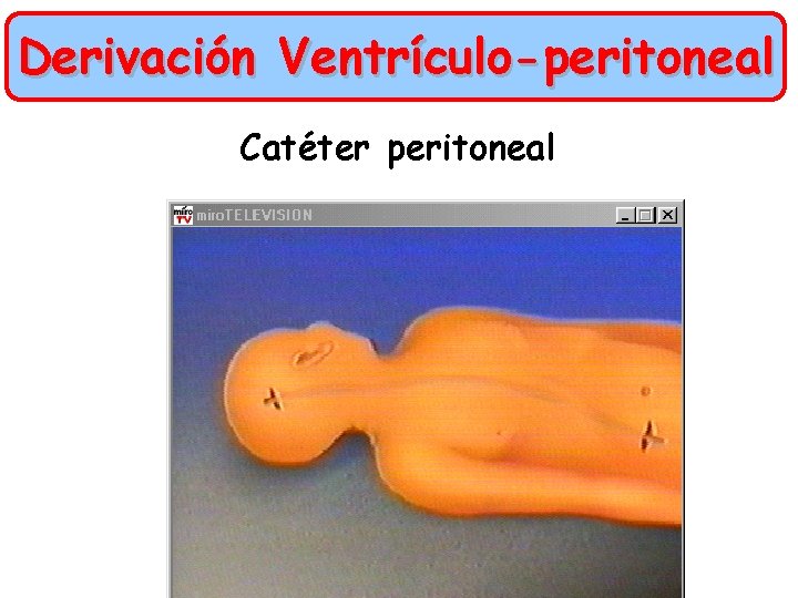 Derivación Ventrículo-peritoneal Catéter peritoneal 