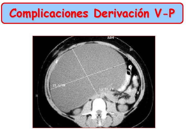 Complicaciones Derivación V-P 